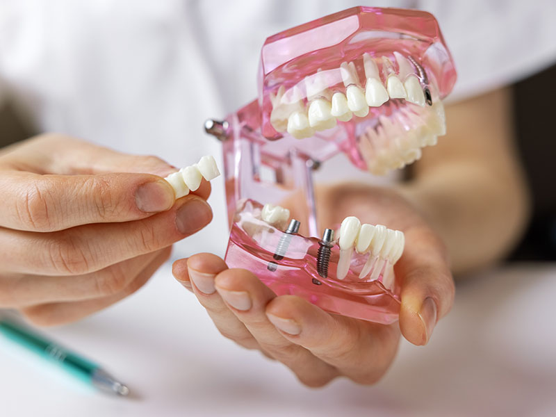 AV Dental | Dental Cleanings, Veneers and Emergency Treatment