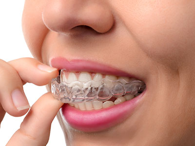 AV Dental | Periodontal Treatment, Dental Bridges and Dentures