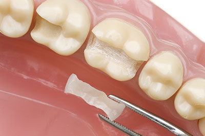 AV Dental | Invisalign reg , Dentures and Implant Dentistry