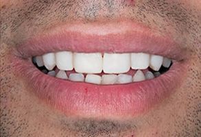 AV Dental | Teeth Whitening, Veneers and Invisalign reg 